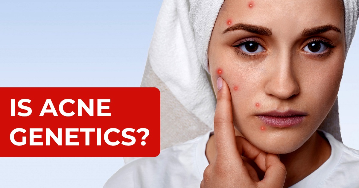 Is Acne Genetics?